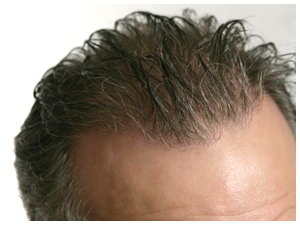 True Hair - Transplant Repair