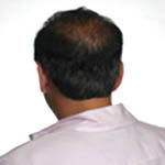 True Hair - Hair Transplants and Hair Replacement Toronto