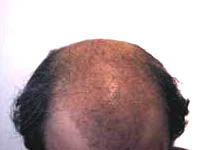 True Hair - Hair Transplants and Hair Replacement Toronto
