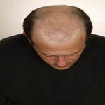 True Hair - Hair Transplants and Hair Replacement Toronto