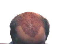 True Hair - Hair Transplants and Hair Replacement Toronto