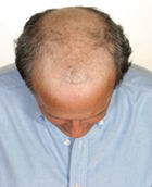 True Hair - Hair Transplants and Hair Replacement Toronto