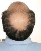 True Hair - Hair Transplants and Hair Replacement Toronto