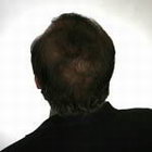 True Hair - Hair Transplants and Hair Replacement Toronto