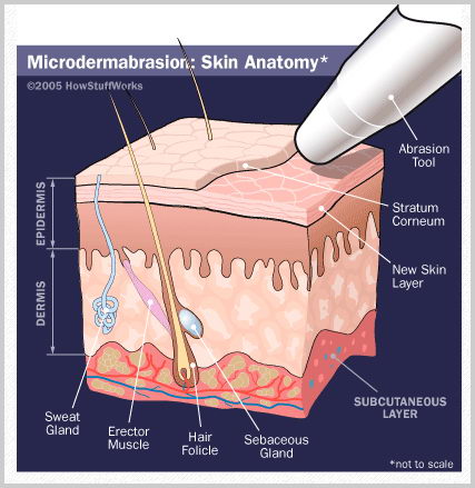 Microderm Abrasion